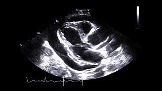 Pericardial Tamponade From a Fractured Inferior Vena Cava (IVC) Stent