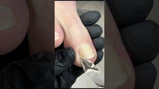 Quick Inflamed Ingrown Nail Removal! #ingrowntoenail #nails