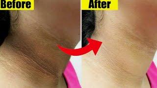 How to get rid of dark neck in 5 minutes | Colgate and lemon for tan removal