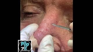 9 minutes of non stop blackhead/whitehead pops. Cyst pops. Acne extractions. Poredirt for days.