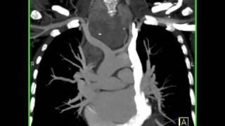 Cardiac: Persistent left superior vena cava emptying into coronary sinus (2 of 4)