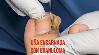 RETIRO DE UÑA ENCARNADA CON GRANULOMA.