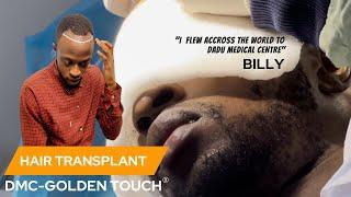 TANZANIA'S BILLY GOT HIS HAIR TRANSPLANT AT OUR CENTRE IN DELHI!| DADU MEDICAL CENTRE