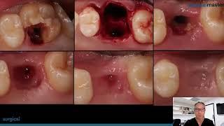 Dr Simon teaches how to handle sinus communications