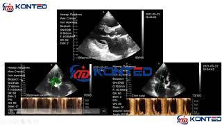 Wifi&USB color doppler Cardiac probe from Beijing Konted