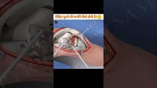 देखिए घुटने की सर्जरी कैसे होती हैं? || See how knee surgery is done. || #ashwanifactsworld #short