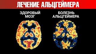 Что провоцирует болезнь Альцгеймера? Революционное открытие