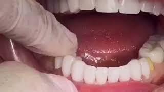 Zirconia Crowns Hollywood Smile Try in, Miami - Dr.Svetlana Anoknina DDS