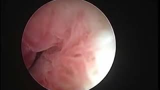 Virgin with hystroscopic endocervical polypectomy by waleed almery