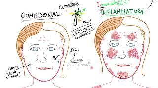 Acne Vulgaris (causes, subtypes and ttt)
