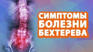 Симптомы болезни Бехтерева // Анкилозирующий спондилоартрит