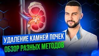 Какой способ удаления камней из почек подойдет именно вам?