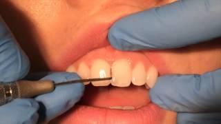 Periodontal Probing