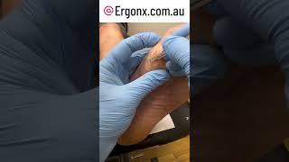 Thick callus (hard skin) cutting in podiatry clinic by podiatrist