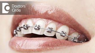 Do teeth become weak & mobile  after Orthodontic Treatment? - Dr. Nandini Nelivigi