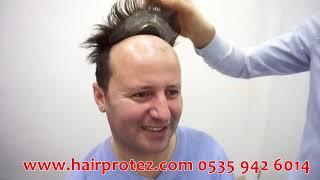 hairprotez com erkek protez sac uygulamasi Protez saç