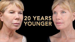 Ponytail Facelift Before and After Part 1 -  Facial Rejuvenation