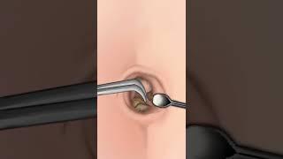 ASMR Navel Stone Belly Button Ring Removal