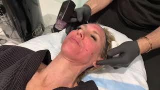 TIGHTEN AND LIFT YOUR FACE IN MINUTES | MICRONEEDLING RF MORPHEUS SKIN TIGHTENING | Dr. Jason Emer