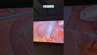 Durbin se surgery kaise hoti hai ? Laparoscopic operation ka tarika kya hai ? Laparoscopic surgery
