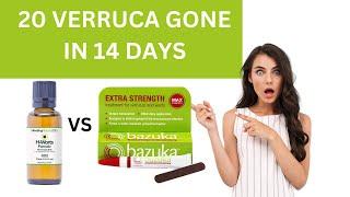 My Results Using H Warts Formula Vs Bazuka Verruca Review