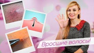 ШОК! Вросшие волосы / Как избавиться - 5 ПРАВИЛ от Яны Осадчей