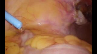 Dr Modi's hysterectomy prev 2 lscs uterus.. 20 Dec 2018