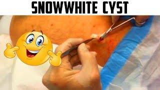 Snowwhite Cyst Redux, John Gilmore M.D.