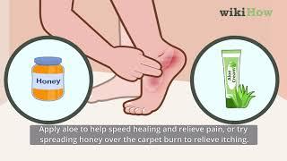 How to Treat Carpet Burns