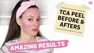 TCA Peel at Home | Before & Afters | Day by Day (Closeups of Results)