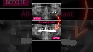 Discover the Perfect Transformation with All-on-6 Implants Supported by Monolithic Zirconia Crowns!