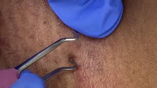 Vajacial Ingrown Hair Removal