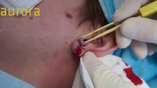 Stretched Earlobe, Tribal Earlobe,  Flesh Tunnel Repair - Aurora Clinics