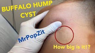 The buffalo hump cyst.Large cyst tucked right up against a pocket of fat cells on posterior neck