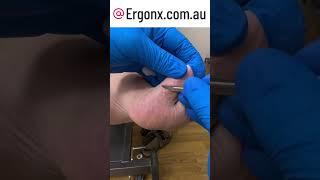 Big toe thick skin (callus) cutting by podiatrist in podiatry clinic