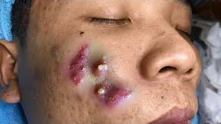 Big Cystic Acne Blackheads Extraction Blackheads & Milia, Whiteheads Removal Pimple Popping