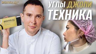 УГЛЫ ДЖОЛИ | СКУЛЫ контурная пластика #скулы #углыджоли #biohyalux