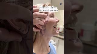 Natural Results| Facelift 3 Months Post-Op| Before and After
