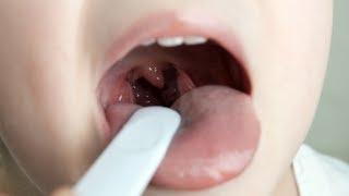 Tonsillectomy Surgery