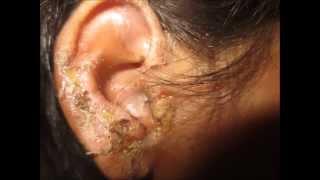 Impetigo +Head Lice Nits