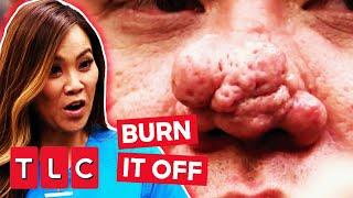 Dr. Lee BURNS OFF Man's Hardened Nose | Dr. Pimple Popper: This Is Zit!