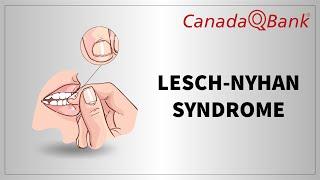 Lesch Nyhan Syndrome