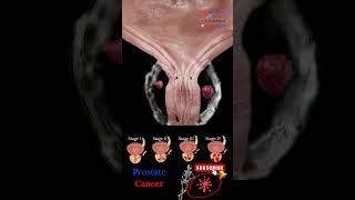 Prostate CAncer 🩺 3D Animation  Medical Arts #shorts