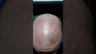 Traya Review After 1 month !! Shocking Results #traya #hairloss #hairlosstreatment