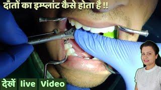 danton ka implant kaise hota hai | dental implant prosthetic procedure