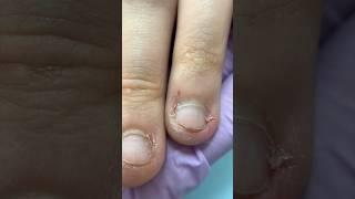 Extreme Bitten Nails Transformation 