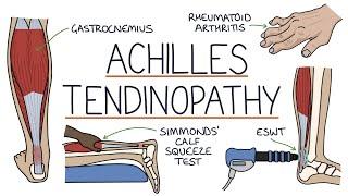 Understanding Achilles Tendinopathy (Achilles Tendinitis)