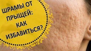 Как Убрать Шрамы от Прыщей (Постакне)