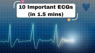 10 Important ECGs (in 1.5 mins) #cardiology #ecg #ekg