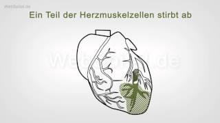 Herzinfarkt - Ursachen und Symptome